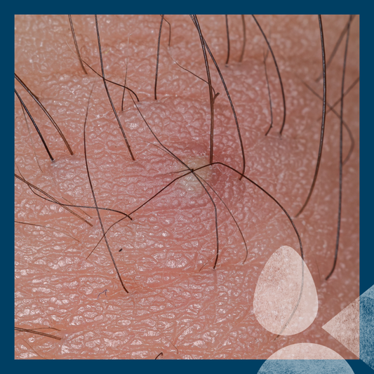 INGROWN HAIRS – WHAT CAUSES THEM AND HOW TO STOP THEM