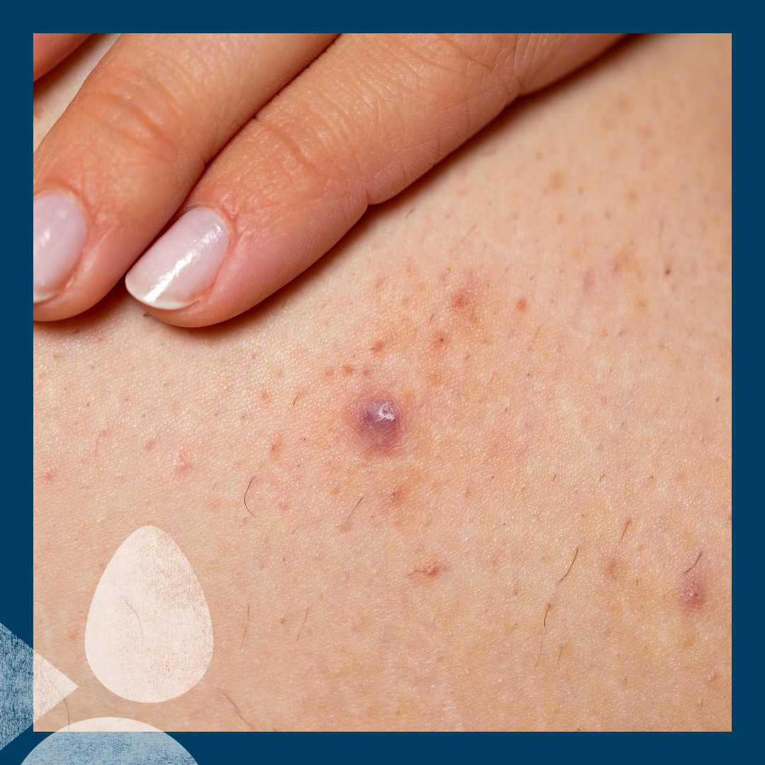 What is Folliculitis?