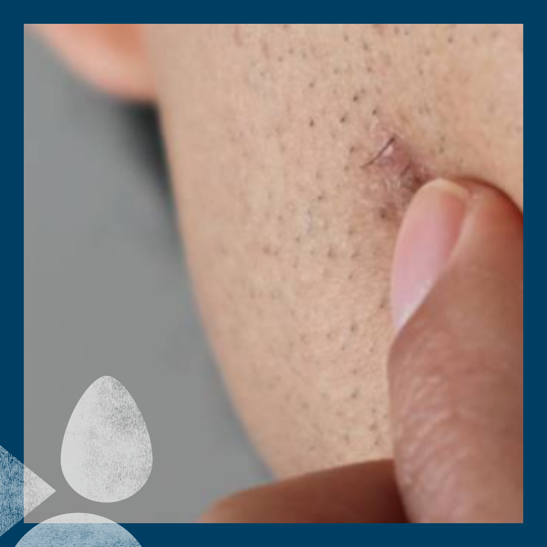 Complete Guide to Ingrown Hair Treatment and Prevention